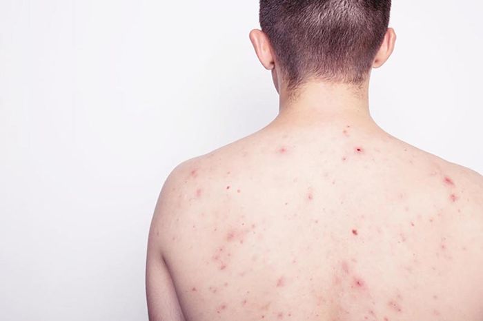 Một trong những dấu hiệu khi nhiễm HIV