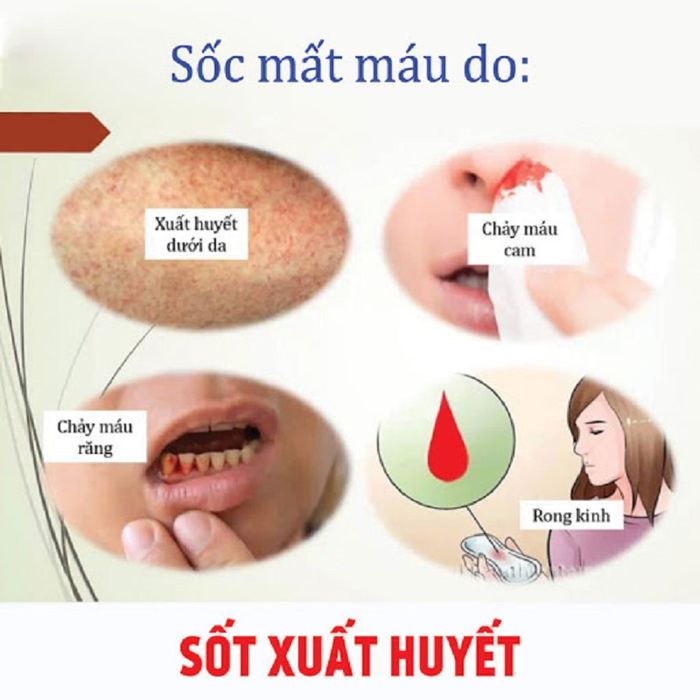 Những dấu hiệu cảnh báo về biến chứng nguy hiểm của sốt xuất huyết