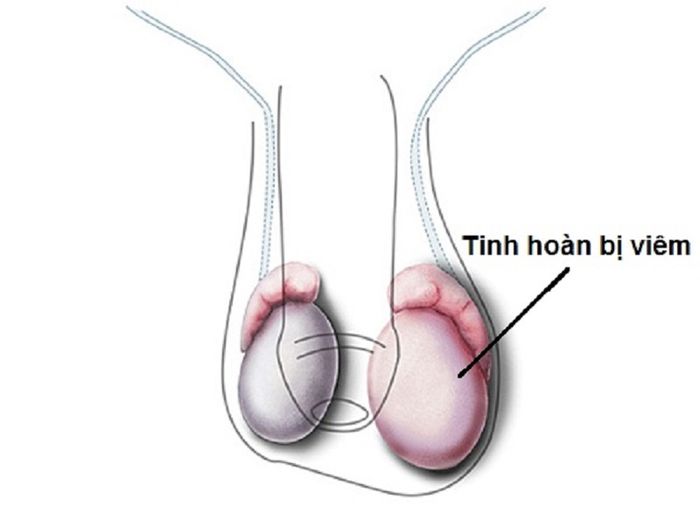 Nam giới có thể gặp biến chứng viêm tinh hoàn sau khi mắc bệnh quai bị