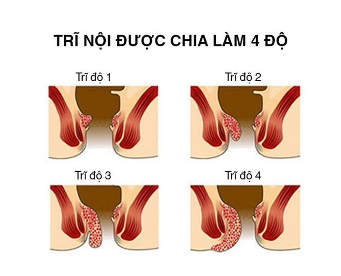 <strong>Các cấp độ của bệnh trĩ nội</strong>