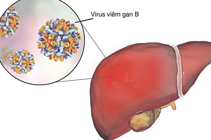 Virus HBV - nguyên nhân gây bệnh viêm gan B nguy hiểm