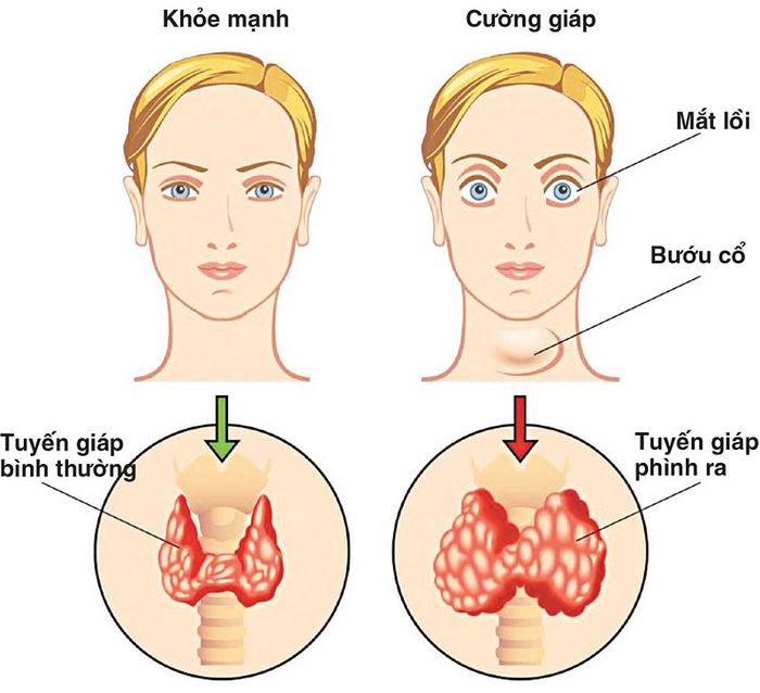 Mô phỏng các dấu hiệu của bướu giáp