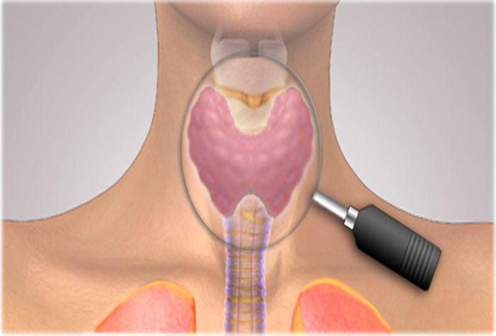 Sử dụng chọc sinh thiết để thực hiện xét nghiệm cho u tuyến giáp thể nhú