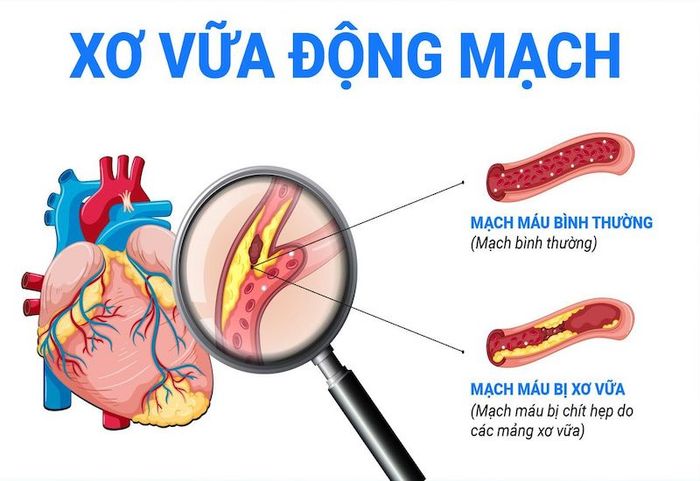 Xơ vữa động mạch là một trong những tác hại của bệnh tiểu đường