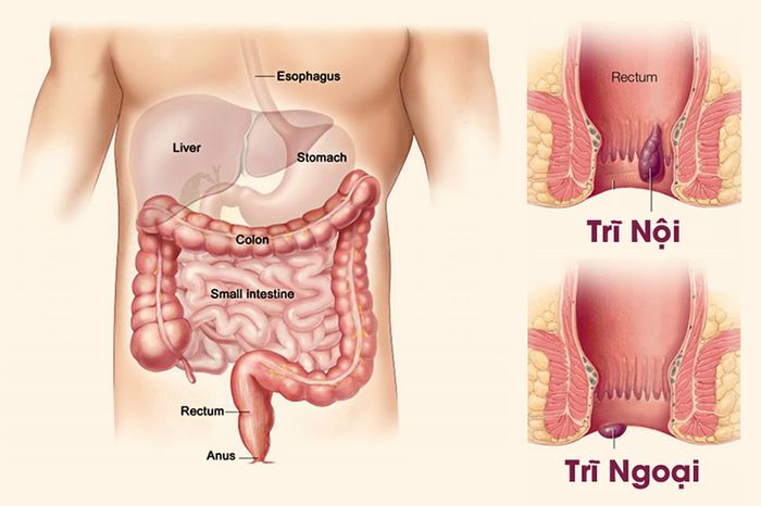 Minh họa các hình ảnh về các dạng của bệnh trĩ