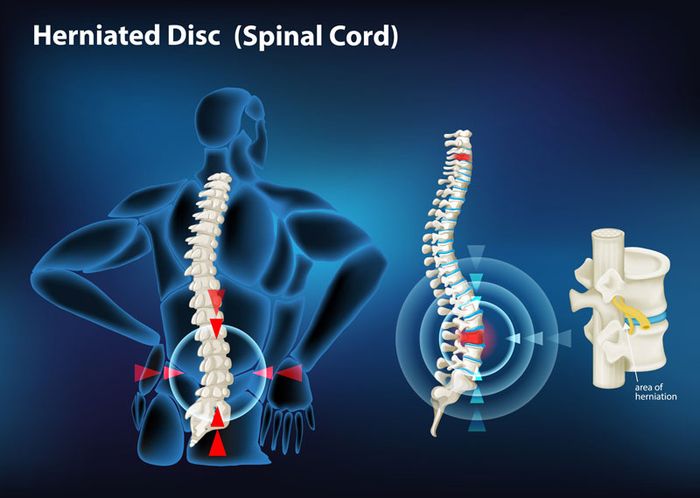 Bệnh nhân cần được phẫu thuật khi có dấu hiệu liệt