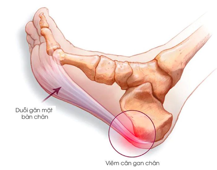 Bệnh lý cân gan chân được hiểu như thế nào?