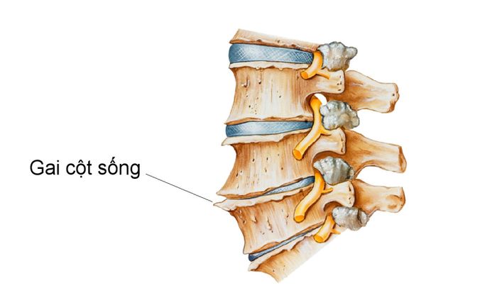 Bệnh thoái hóa cột sống còn được biết đến với tên gọi khác là bệnh gai cột sống. Điều này xuất phát từ việc ở các vị trí bên ngoài hoặc hai bên của cột sống hình thành các phần xương giống như gai. Tuy bệnh có thể xuất hiện ở nhiều vị trí trên cột sống, nhưng thường gặp nhất ở cột sống thắt lưng và cổ.