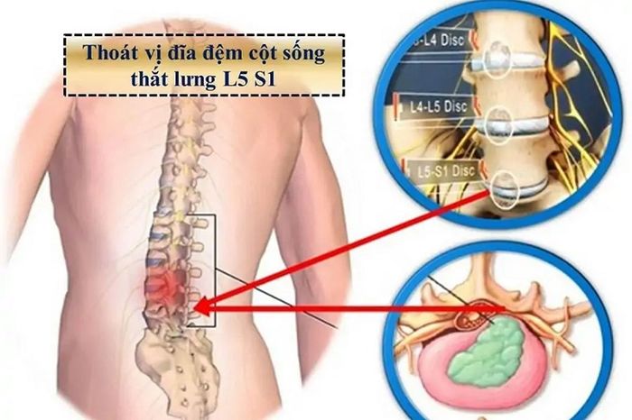 Các vị trí đốt sống thường bị thoát vị đĩa đệm