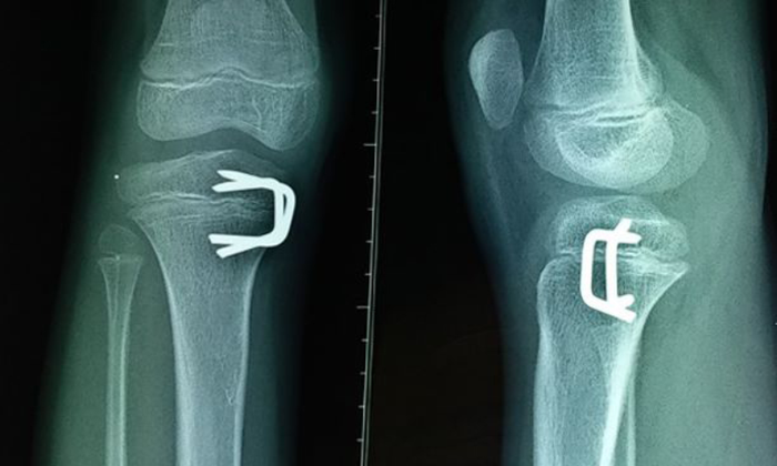 Sụn tăng trưởng - một cấu trúc dễ bị tổn thương