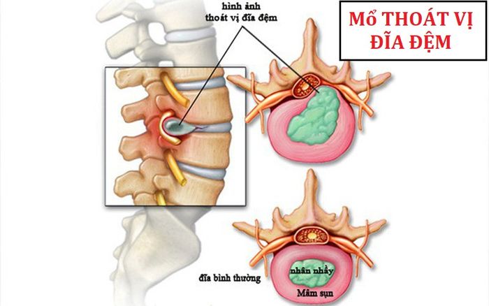 Khi các biện pháp khác không mang lại hiệu quả, phẫu thuật thoát vị đĩa đệm là lựa chọn cần thiết