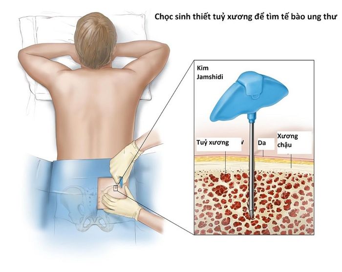 Sử dụng kỹ thuật sinh thiết xương để xác định u xương ác tính