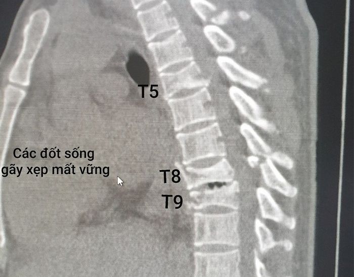 Hình ảnh CT cắt lớp minh họa về bệnh nhân mắc bệnh gãy nén đốt sống