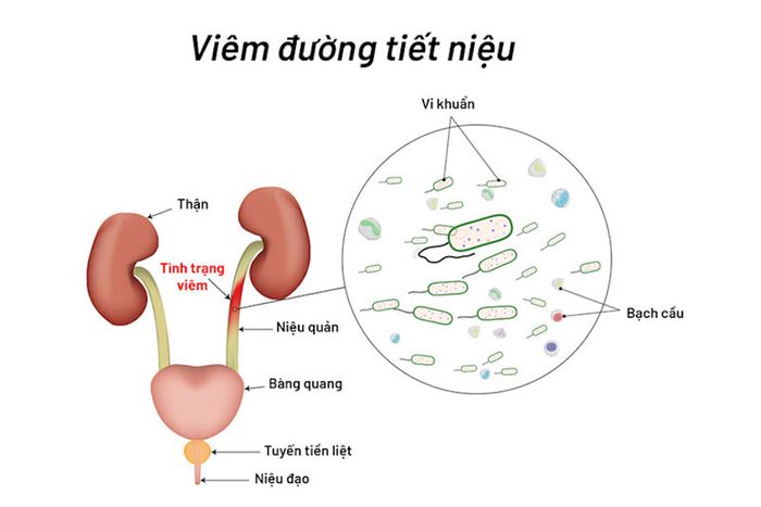 Viêm đường tiết niệu - một trong những nguyên nhân chính gây ra tiểu buốt