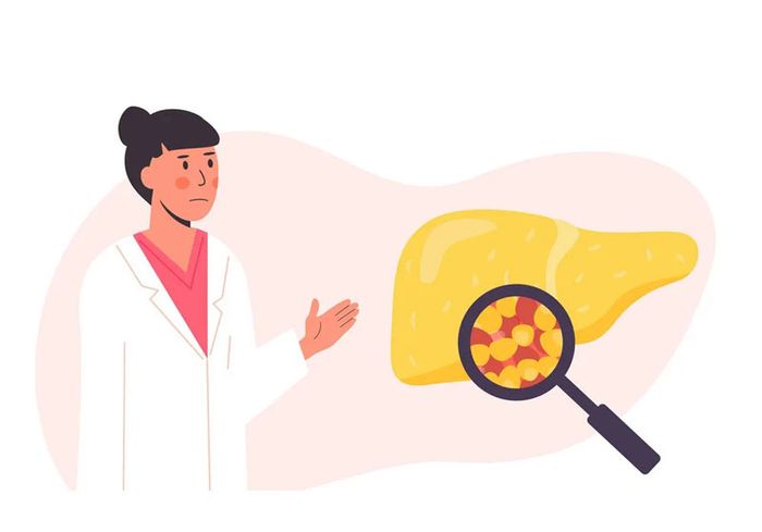 Gan nhiễm mỡ có bao nhiêu cấp độ là thắc mắc của nhiều người
