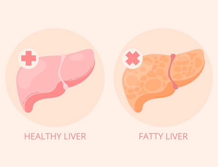Gan nhiễm mỡ là tình trạng khá phổ biến