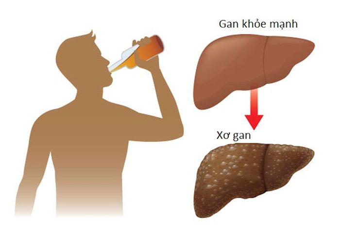 Người nghiện rượu bia thường có nguy cơ mắc bệnh xơ gan cao