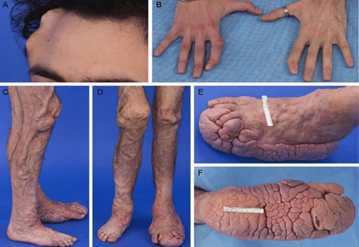 Triệu chứng của hội chứng người voi rất đa dạng