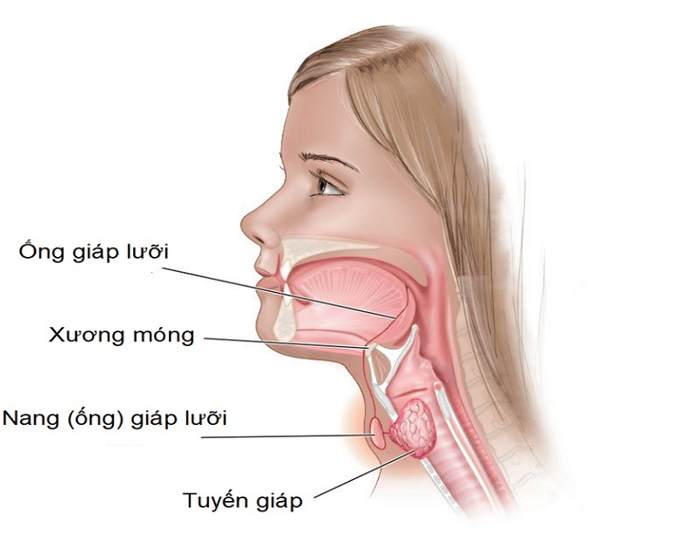 Ung thư giáp lưỡi