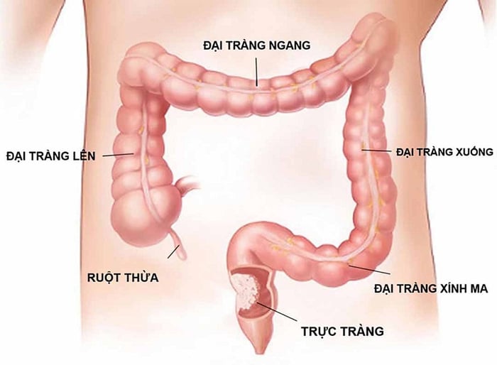 viêm loét trực tràng, đại tràng