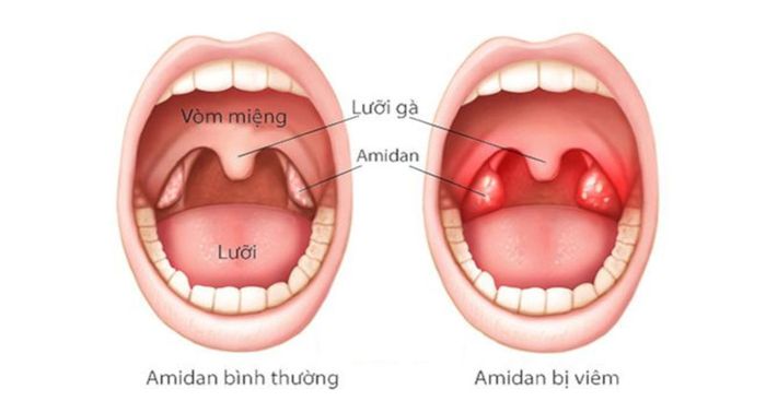 Trẻ em dễ mắc bệnh viêm amidan.