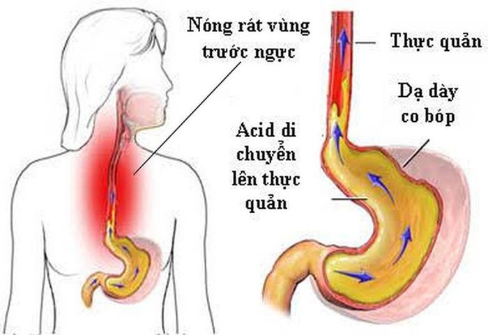 Ngủ chảy dãi do bệnh trào ngược dạ dày