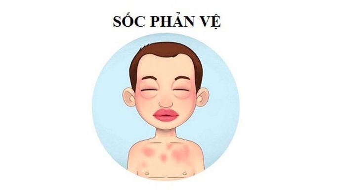 Sốc ngược là một dạng phản ứng dị ứng cấp tính