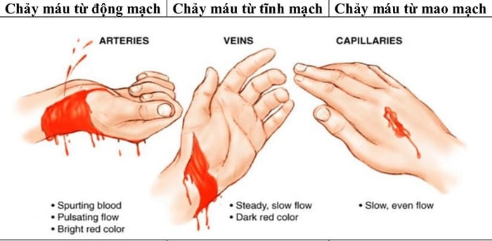 Cách nhận biết vị trí chảy máu để đánh giá mức độ nguy hiểm