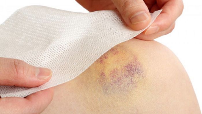 Bầm tím dưới da có thể là dấu hiệu của giảm tiểu cầu