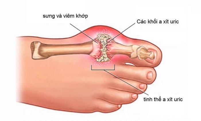 Tăng acid uric trong máu là nguyên nhân chính gây ra bệnh gout