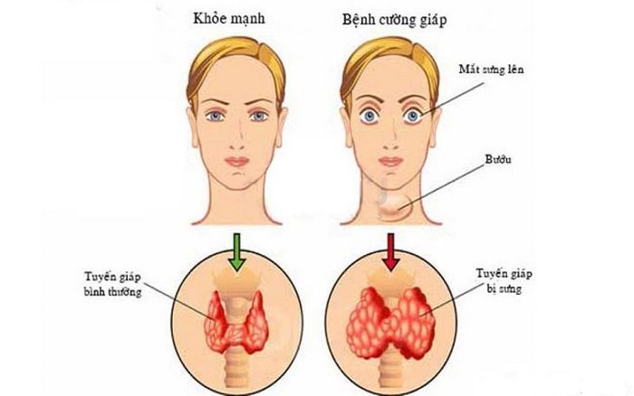 Mô tả các triệu chứng của cường giáp