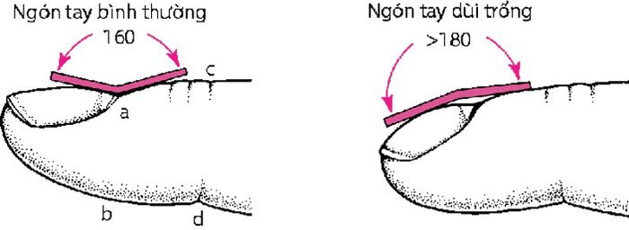 Dấu hiệu để xác định chẩn đoán