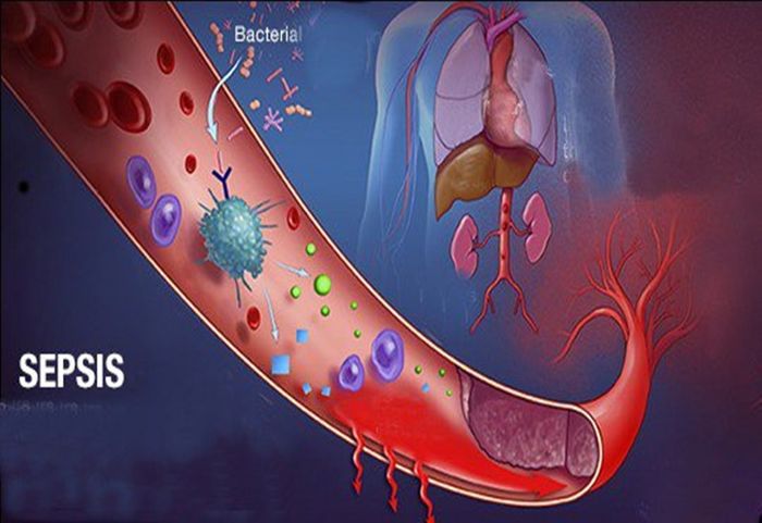 Nhiều người chưa hiểu rõ Sepsis là bệnh gì