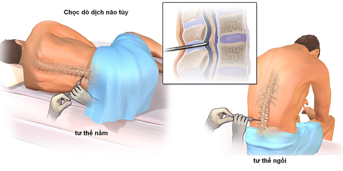 Việc chọc dò dịch não tủy giúp chẩn đoán và lập phác đồ điều trị cho bệnh đa u tủy xương.