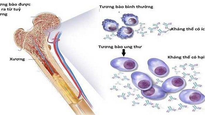 Hình thành bệnh đa u tủy xương do sự tăng sinh không bình thường của tương bào