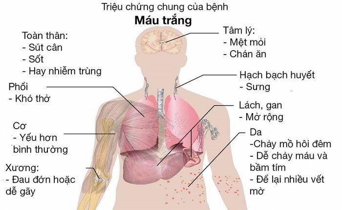 Dấu hiệu thường gặp ở người mắc bệnh bạch cầu