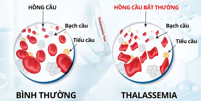 Hội chứng Tan Máu: Bệnh Di Truyền và Biện Pháp Phòng Tránh