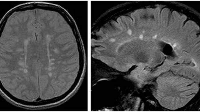 Chụp MRI giúp chẩn đoán chính xác bệnh đa xơ cứng