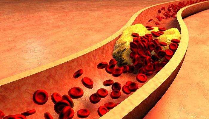 Mỡ trong máu cao là hiện tượng tăng lượng cholesterol xấu trong cơ thể