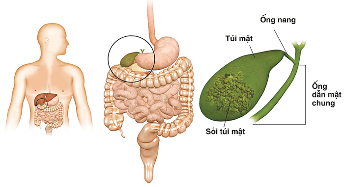 Cắt túi mật là phương pháp cần thiết khi sỏi mật gây biến chứng.