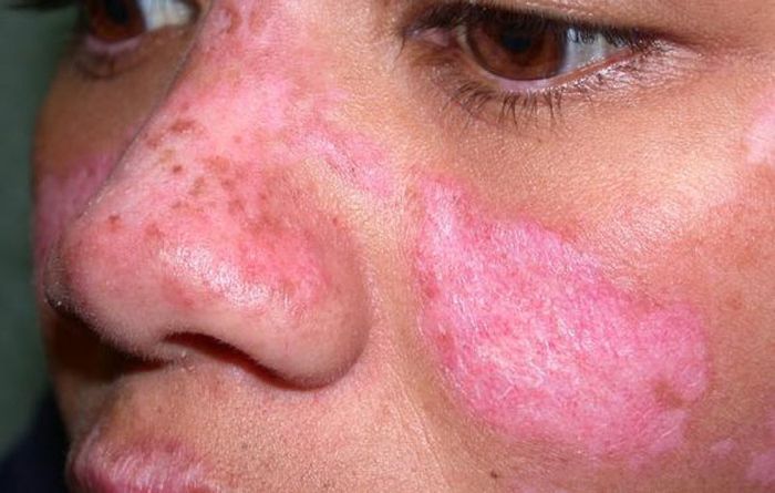 Lupus ban đỏ dạng đĩa là một loại bệnh tự miễn thường gặp