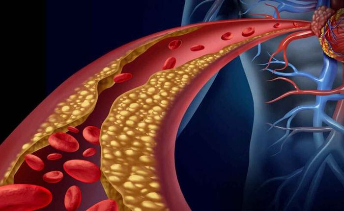 Rối loạn lipid máu là một trong những nguyên nhân chính gây ra biến chứng nguy hiểm liên quan đến tim mạch.