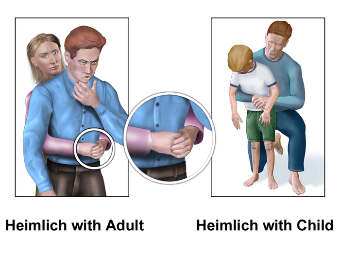 Thao tác ép bụng và vỗ lưng giúp đẩy xương cá ra ngoài