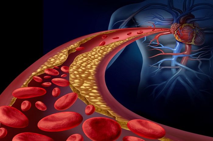 Rối loạn lipid máu xảy ra khi hàm lượng Cholesterol và Triglycerid tăng không bình thường, và HDL - Cholesterol tốt giảm.