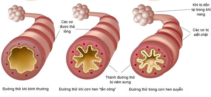 Hen phế quản: Bệnh viêm đường hô hấp mạn tính nguy hiểm