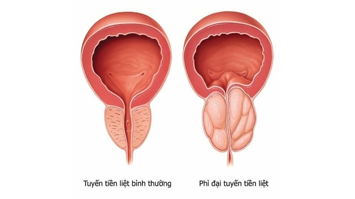 Biểu hiện của phì đại tuyến tiền liệt ở nam giới