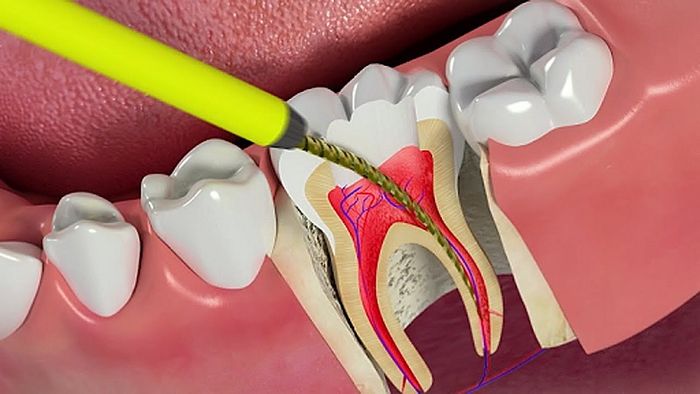 Chữa tủy răng khi cần thiết sẽ giúp ngăn ngừa hậu quả xấu do nhiễm trùng tủy gây ra