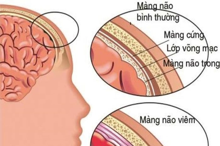 Cảm giác sốt vào buổi chiều do nhiễm khuẩn màng não