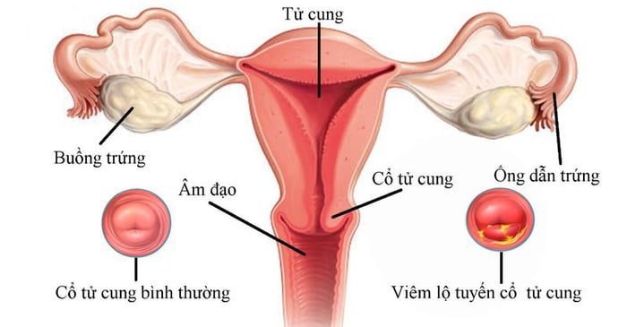 Sau khi quan hệ, phụ nữ mắc viêm nang cổ tử cung thường gặp đau bụng