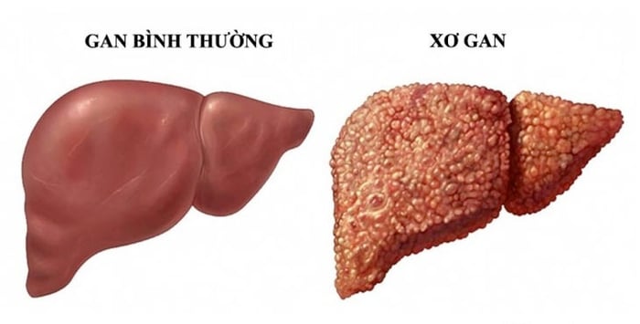 Nguy hiểm của bệnh xơ gan khi tế bào gan bị tổn thương kéo dài